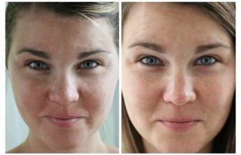 These Rodan and Fields before and after pictures were taken with zero make-up, in the same spot in my house, with the same lighting! I'm truly amazing and impressed by these results after using R + F's Reverse regimen.